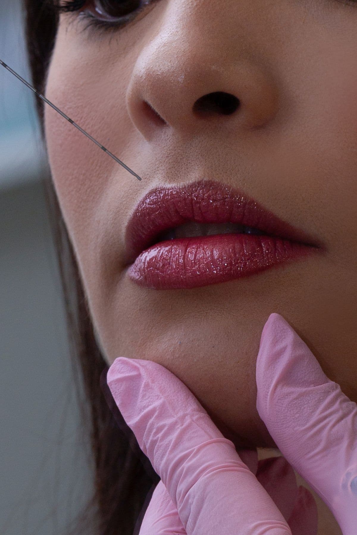 A tasteful dermal filler treatment