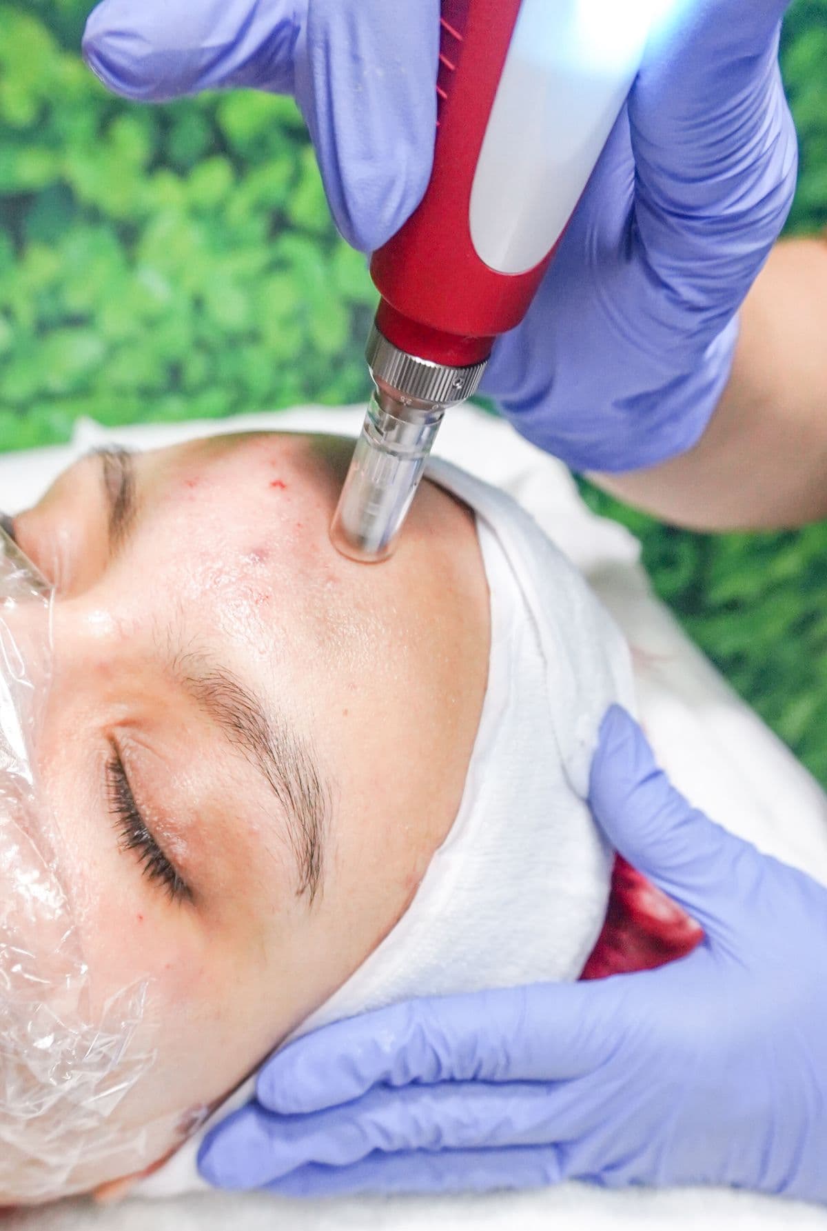 A gentle skin-resurfacing facial treatment